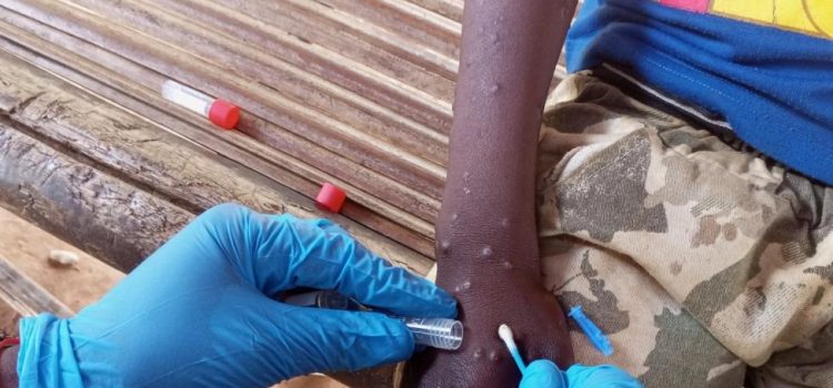 IOM Appeals for USD 18.5 Million to Urgently Aid Mpox-Affected Populations in East, Southern Africa