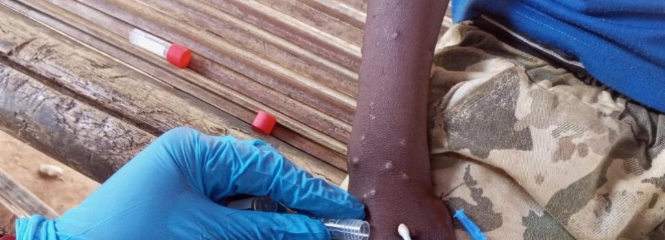 IOM Appeals for USD 18.5 Million to Urgently Aid Mpox-Affected Populations in East, Southern Africa