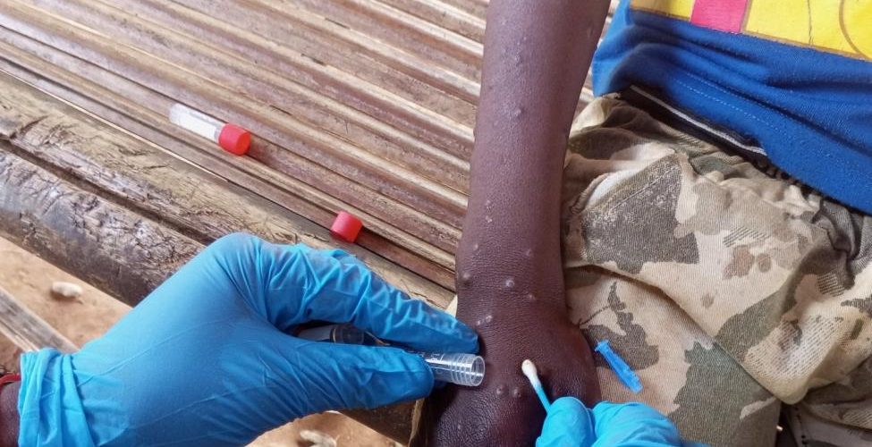 IOM Appeals for USD 18.5 Million to Urgently Aid Mpox-Affected Populations in East, Southern Africa