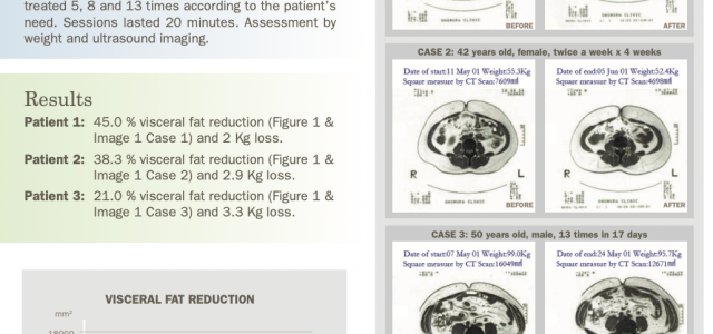 Case Study Highlights INDIBA 448 kHz Radiofrequency’s Role in Visceral Fat Reduction and Prevention of Fat Accumulation