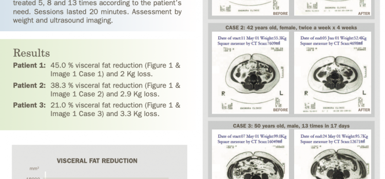 Case Study Highlights INDIBA 448 kHz Radiofrequency’s Role in Visceral Fat Reduction and Prevention of Fat Accumulation